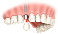 An implant support a single tooth replacement