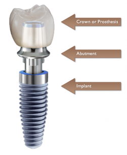 A single dental implant with crown